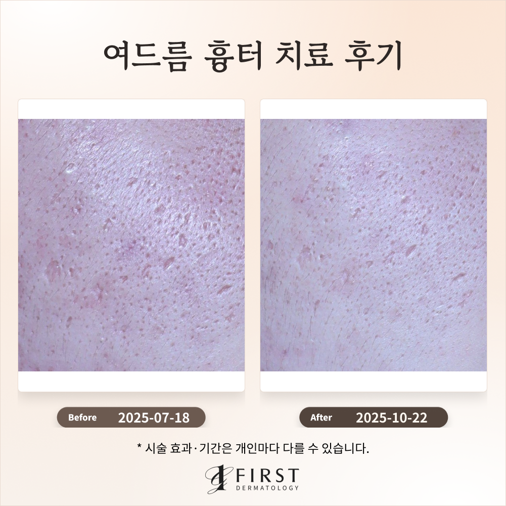 20대 여드름 흉터 치료 과정 소개 #효과적인 치료방법