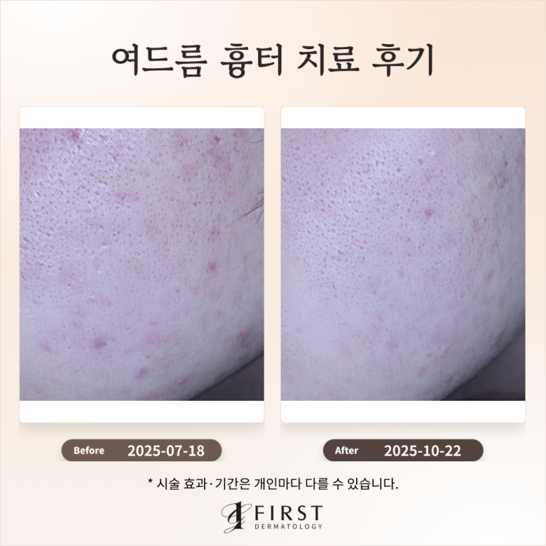 20대 여드름 흉터 치료 과정 소개 #효과적인 치료방법