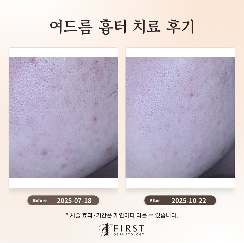 20대 여드름 흉터 치료 과정 소개 #효과적인 치료방법