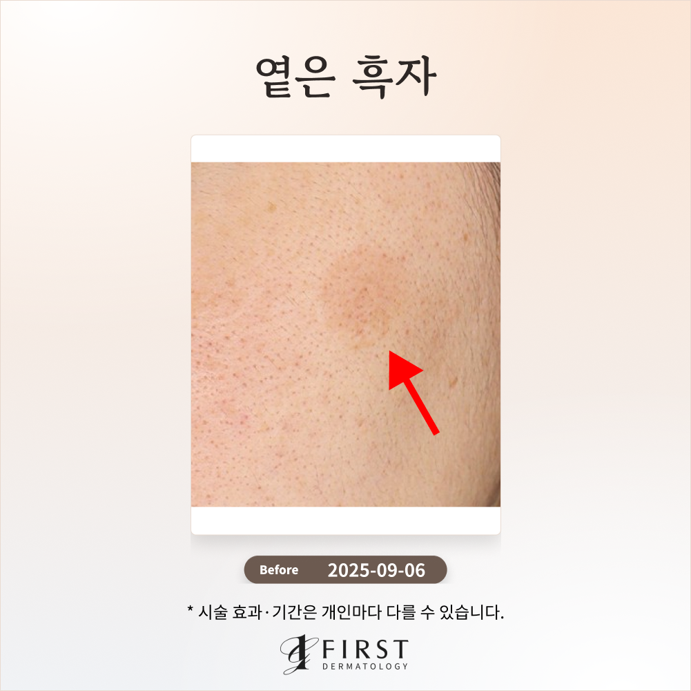 30대 여성 옅은 갈색 반점(흑자) 제거 후기 #흑자제거방법