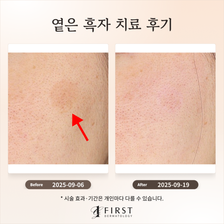 30대 여성 옅은 갈색 반점(흑자) 제거 후기 #흑자제거방법