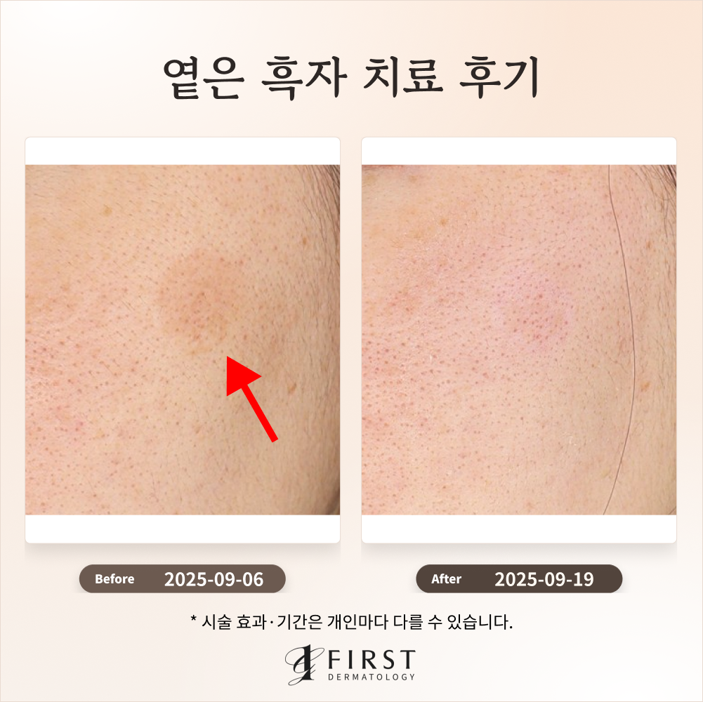 30대 여성 옅은 갈색 반점(흑자) 제거 후기 #흑자제거방법