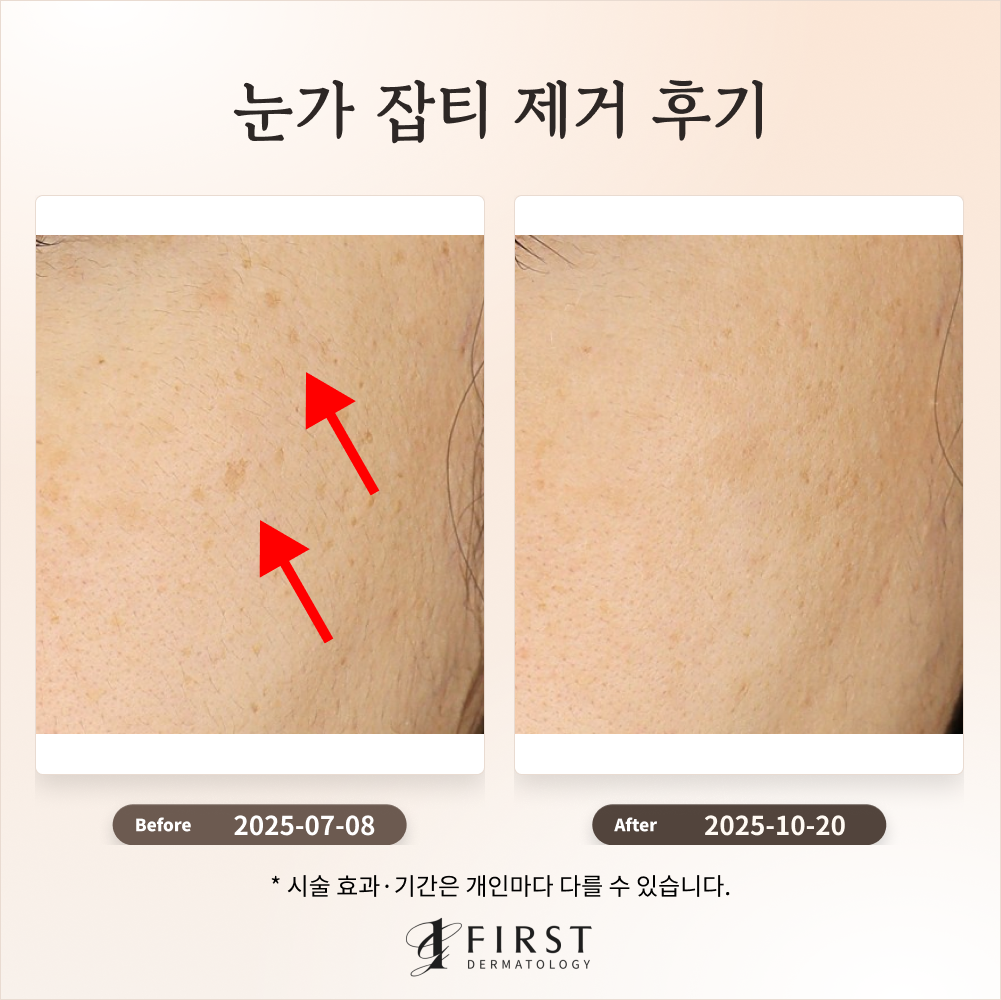 눈가 부위 잡티, 기미 개선 후기 #잡티제거방법