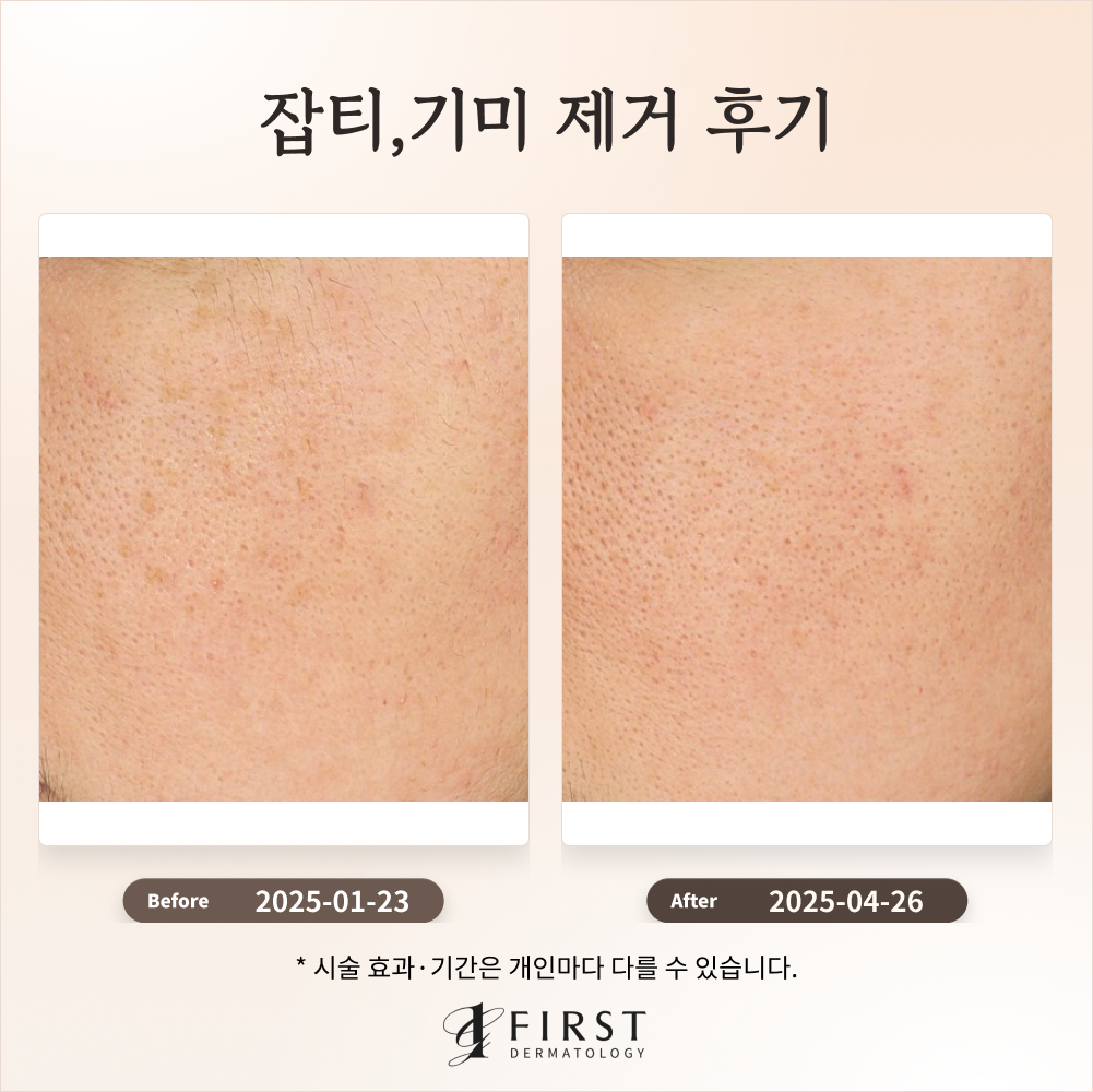 30대 여성 레이저 토닝으로 잡티 개선 후기 #잡티 제거 방법