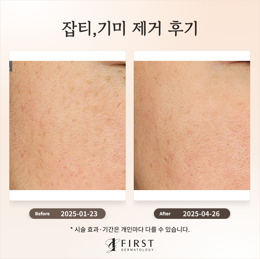 30대 여성 레이저 토닝으로 잡티 개선 후기 #잡티 제거 방법
