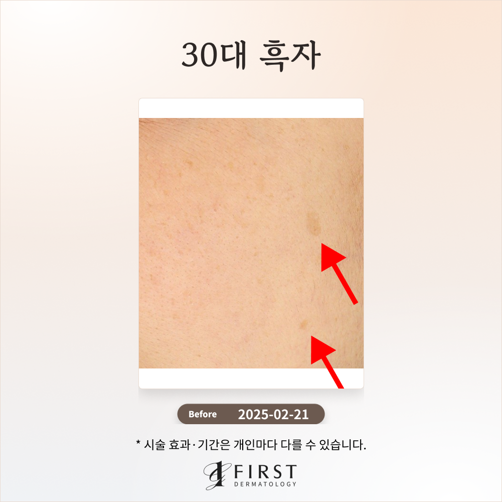 30대 옅은 갈색 반점(흑자) 제거 후기