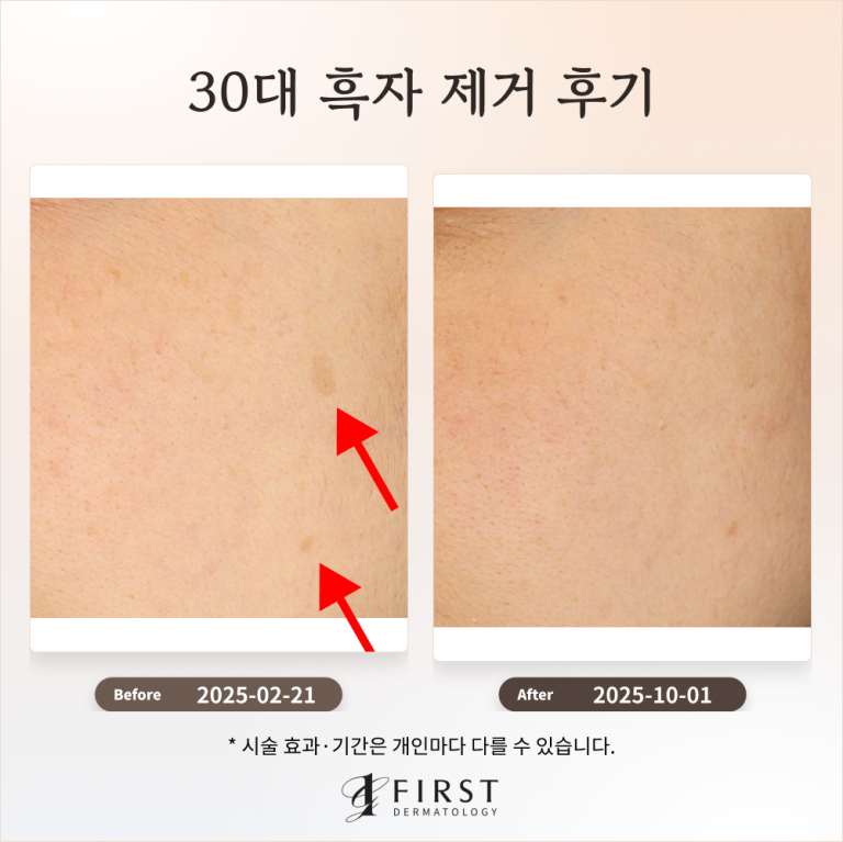 30대 옅은 갈색 반점(흑자) 제거 후기