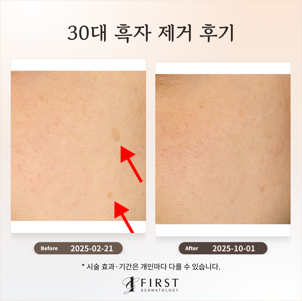 30대 옅은 갈색 반점(흑자) 제거 후기