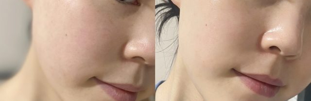 스킨보톡스 시술 안내 이미지