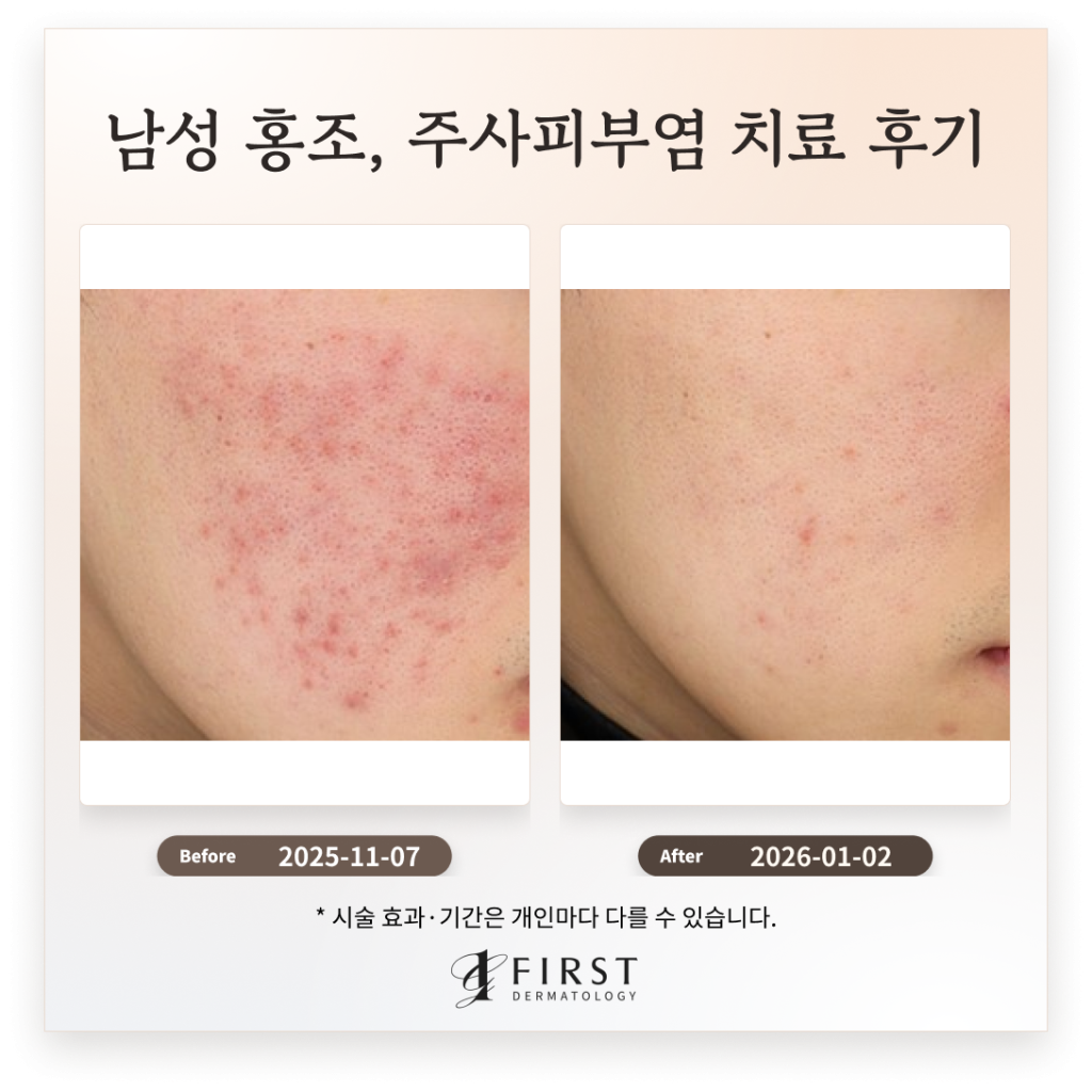 20대 남성 홍조, 주사피부염 치료 후기_ 효과적인 치료 방법 소개