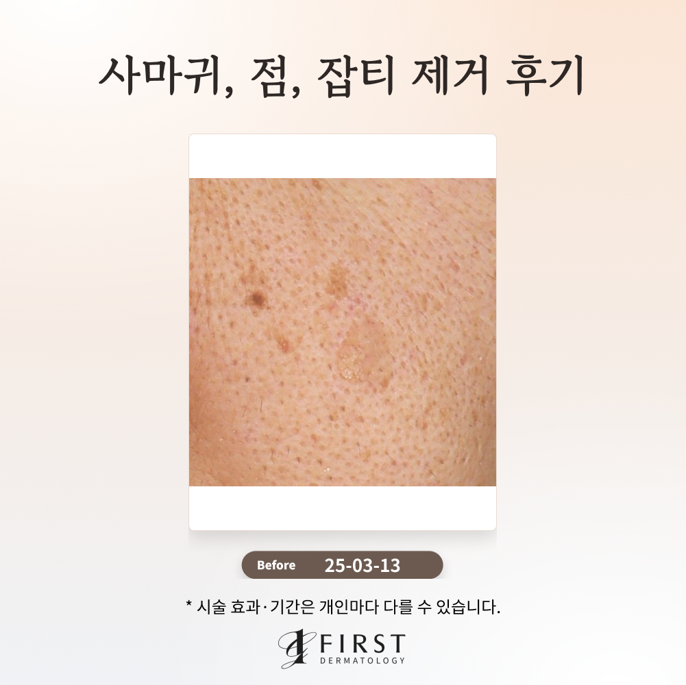 40대 남성 사마귀, 점, 잡티 제거 후기