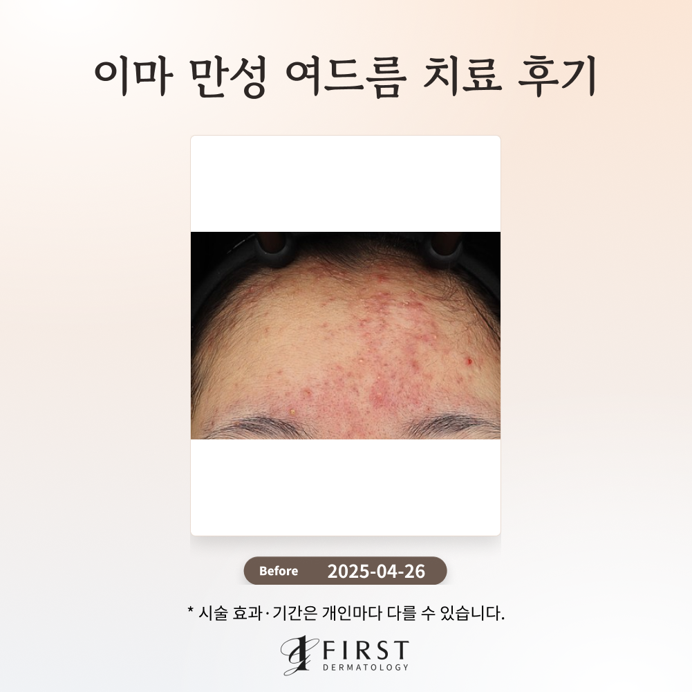 이마 만성 여드름 치료 후기_ 여드름 피부과 치료 방법 소개