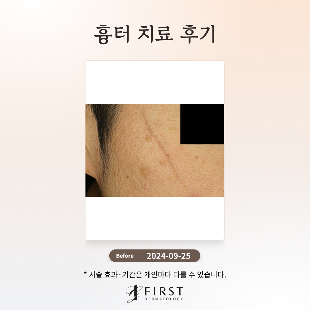 흉터 치료 방법 후기로 살펴보기_피부과 전문의