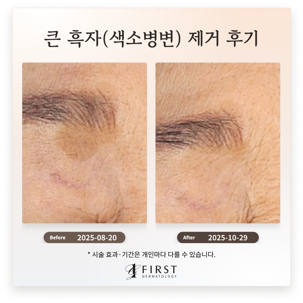60대 여성 얼굴 곳곳에 위치한 큰 흑자(색소병변) 제거 후기_수원 색소 피부과