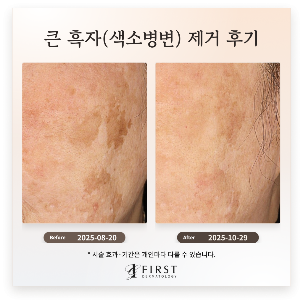 60대 여성 얼굴 곳곳에 위치한 큰 흑자(색소병변) 제거 후기_수원 색소 피부과