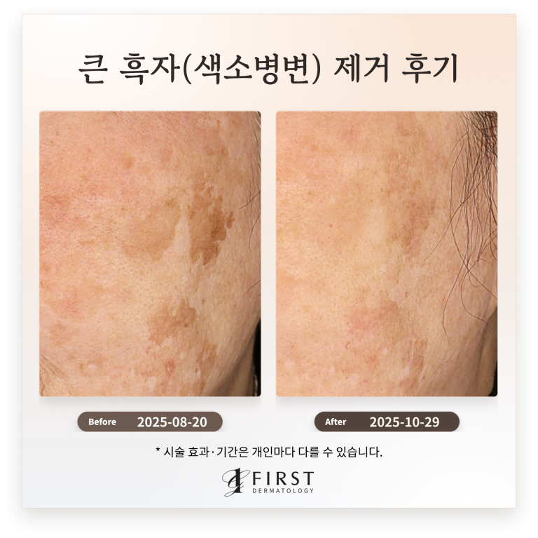 60대 여성 얼굴 곳곳에 위치한 큰 흑자(색소병변) 제거 후기_수원 색소 피부과