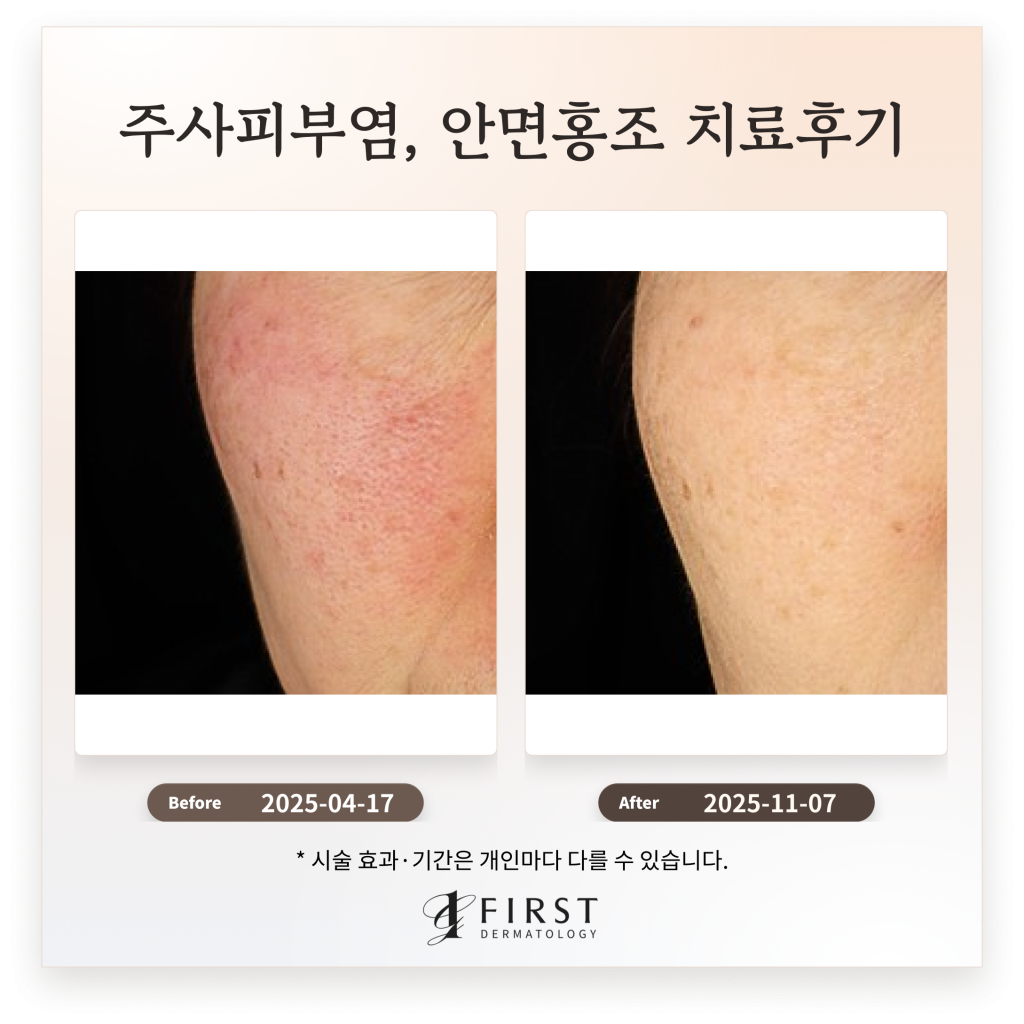 60대 주사피부염, 안면홍조 치료후기_피부과 전문의