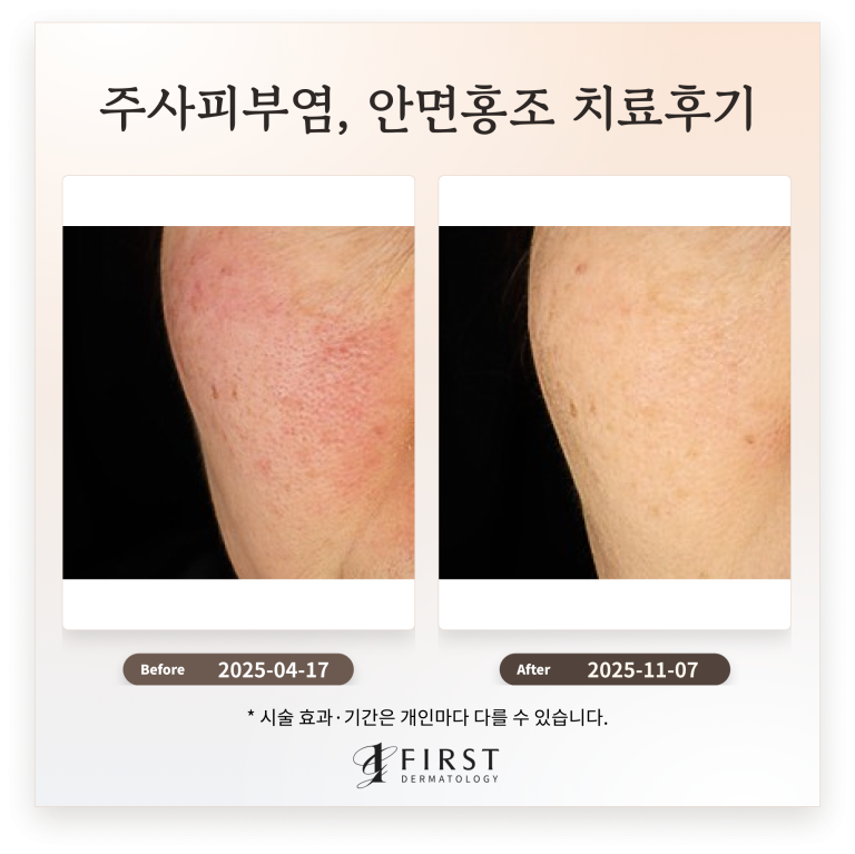 60대 주사피부염, 안면홍조 치료후기_피부과 전문의