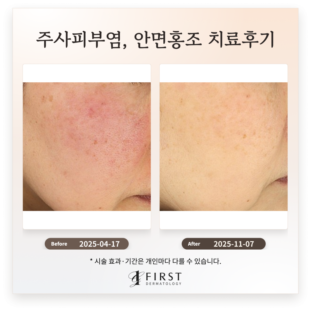 60대 주사피부염, 안면홍조 치료후기_피부과 전문의