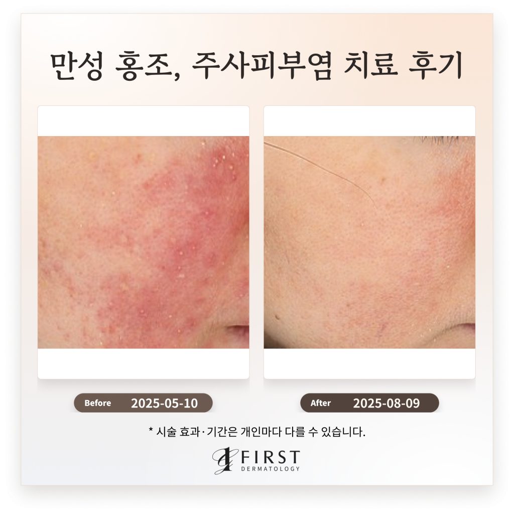 만성 홍조, 주사피부염 치료 후기_브이빔 치료 효과