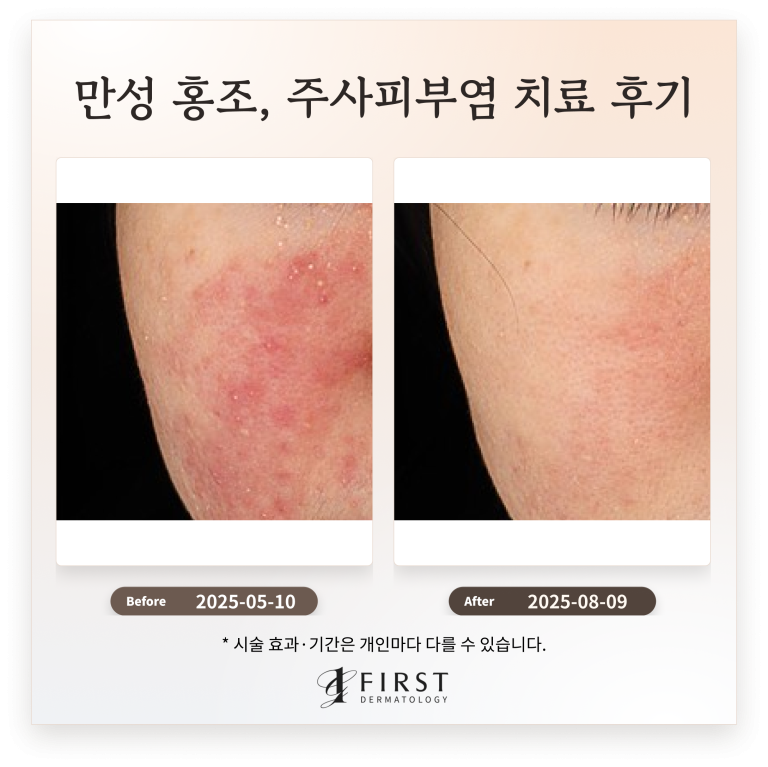 만성 홍조, 주사피부염 치료 후기_브이빔 치료 효과