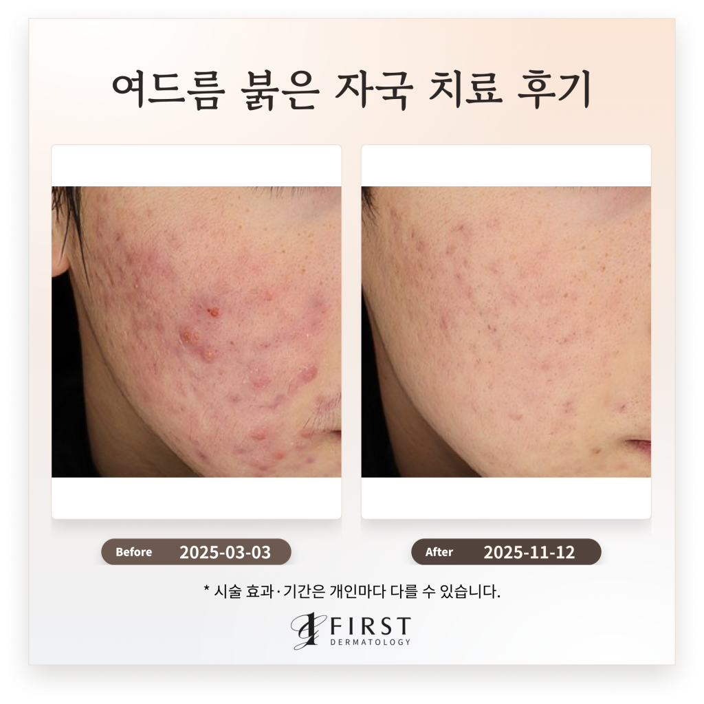 20대 남성 여드름, 여드름 붉은 자국 치료 후기_수원 피부과 전문의