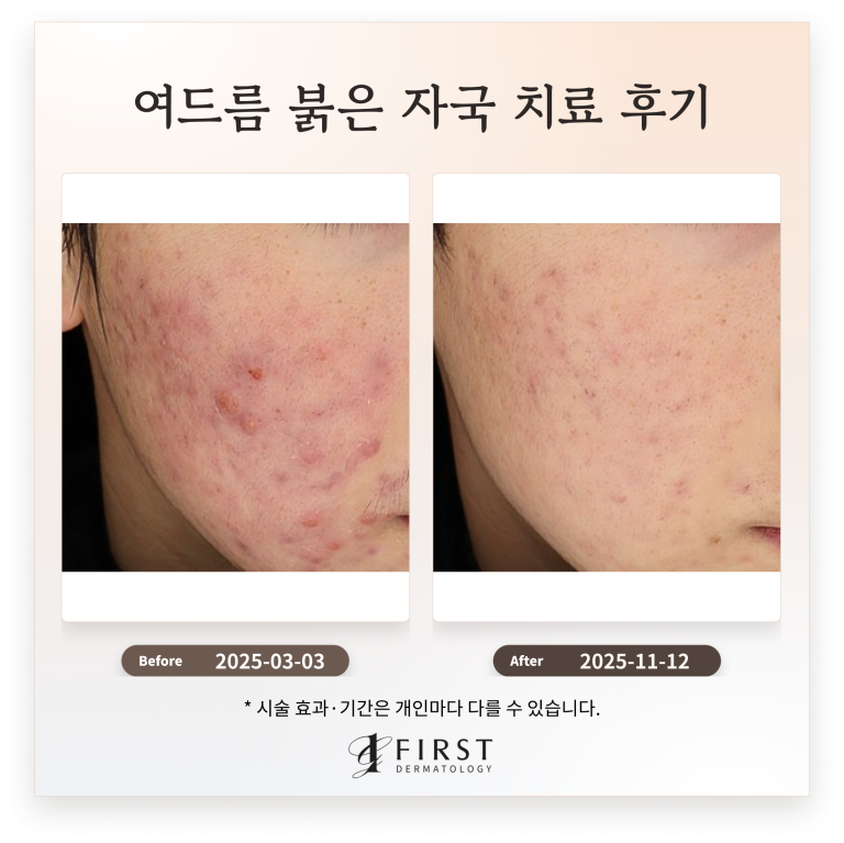 20대 남성 여드름, 여드름 붉은 자국 치료 후기_수원 피부과 전문의