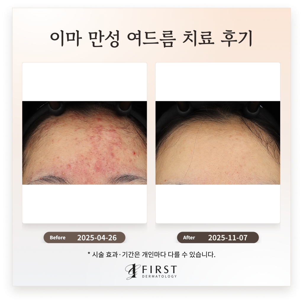 이마 만성 여드름 치료 후기_ 여드름 피부과 치료 방법 소개