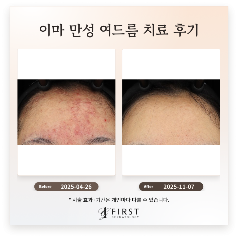 이마 만성 여드름 치료 후기_ 여드름 피부과 치료 방법 소개