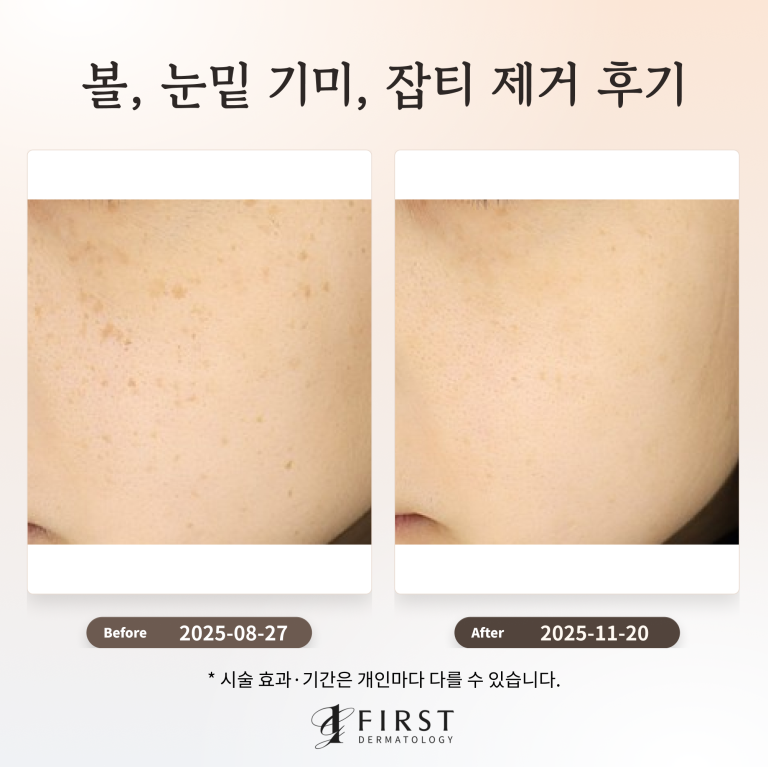 볼, 눈밑 기미, 잡티 제거 후기_수원 색소 피부과 전문의