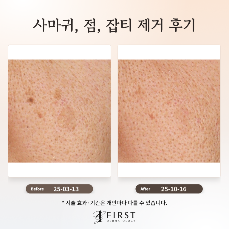 40대 남성 사마귀, 점, 잡티 제거 후기
