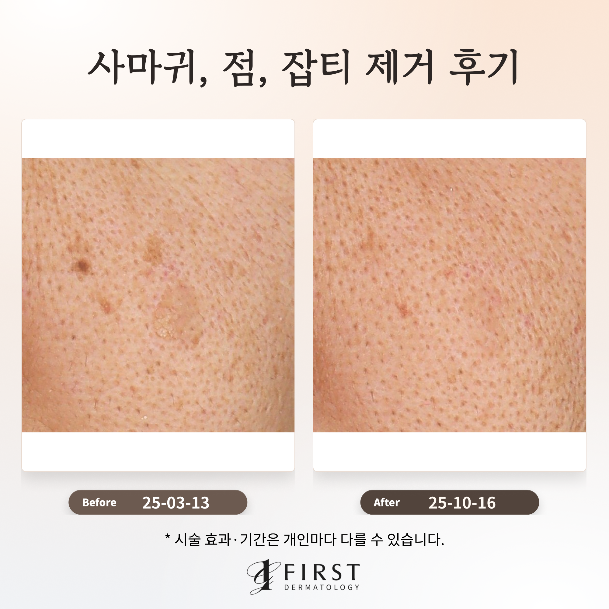 40대 남성 사마귀, 점, 잡티 제거 후기