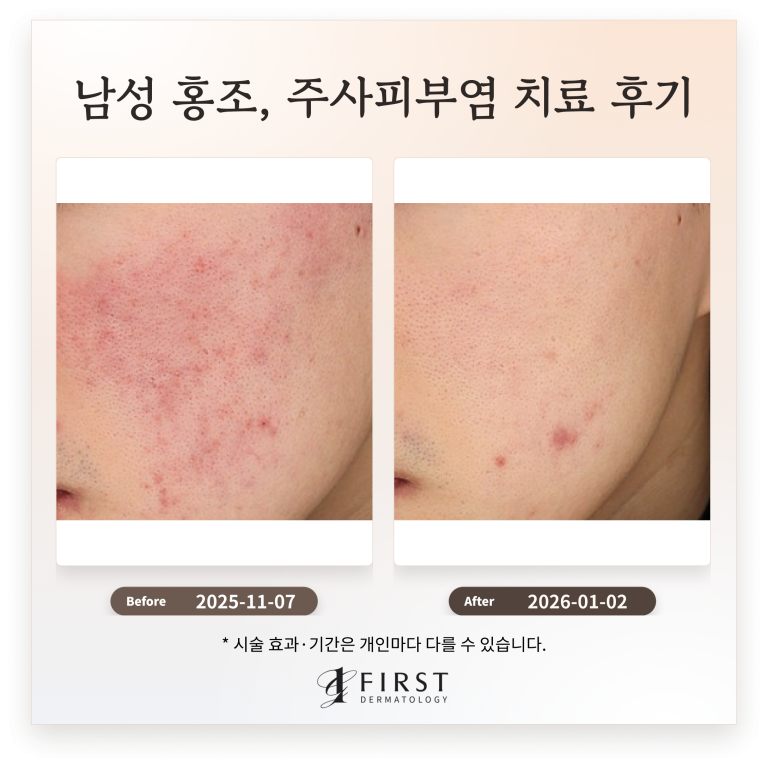 20대 남성 홍조, 주사피부염 치료 후기_ 효과적인 치료 방법 소개