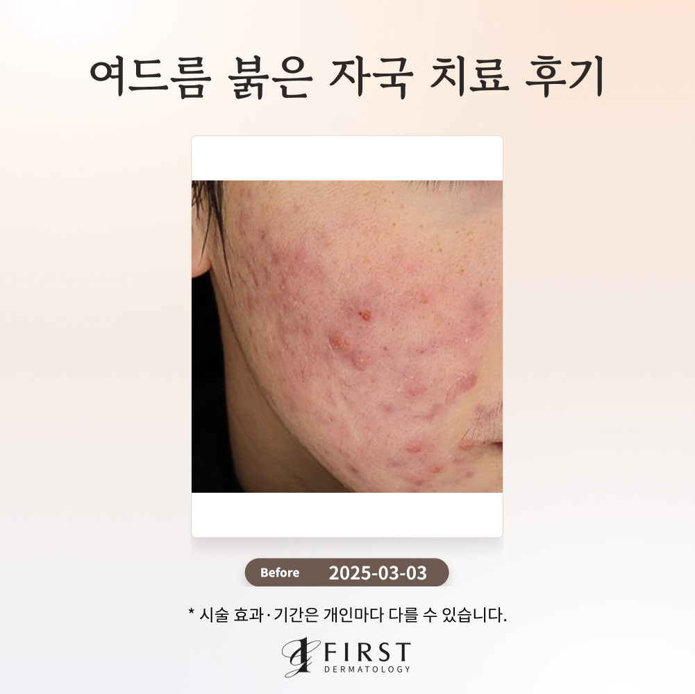 20대 남성 여드름, 여드름 붉은 자국 치료 후기_수원 피부과 전문의