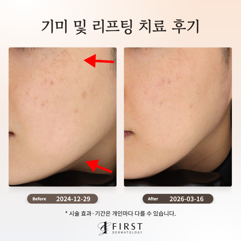 기미 및 리프팅 치료 후기