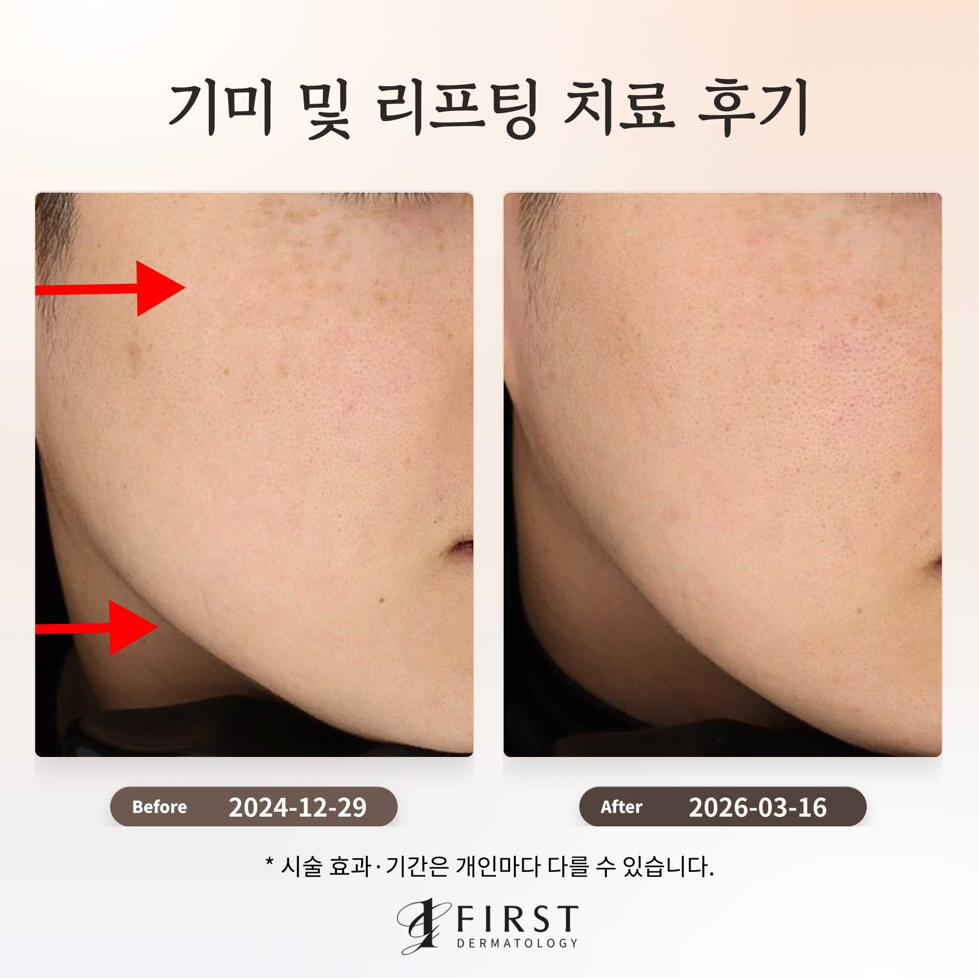 리프팅과 색소 복합 치료 기록