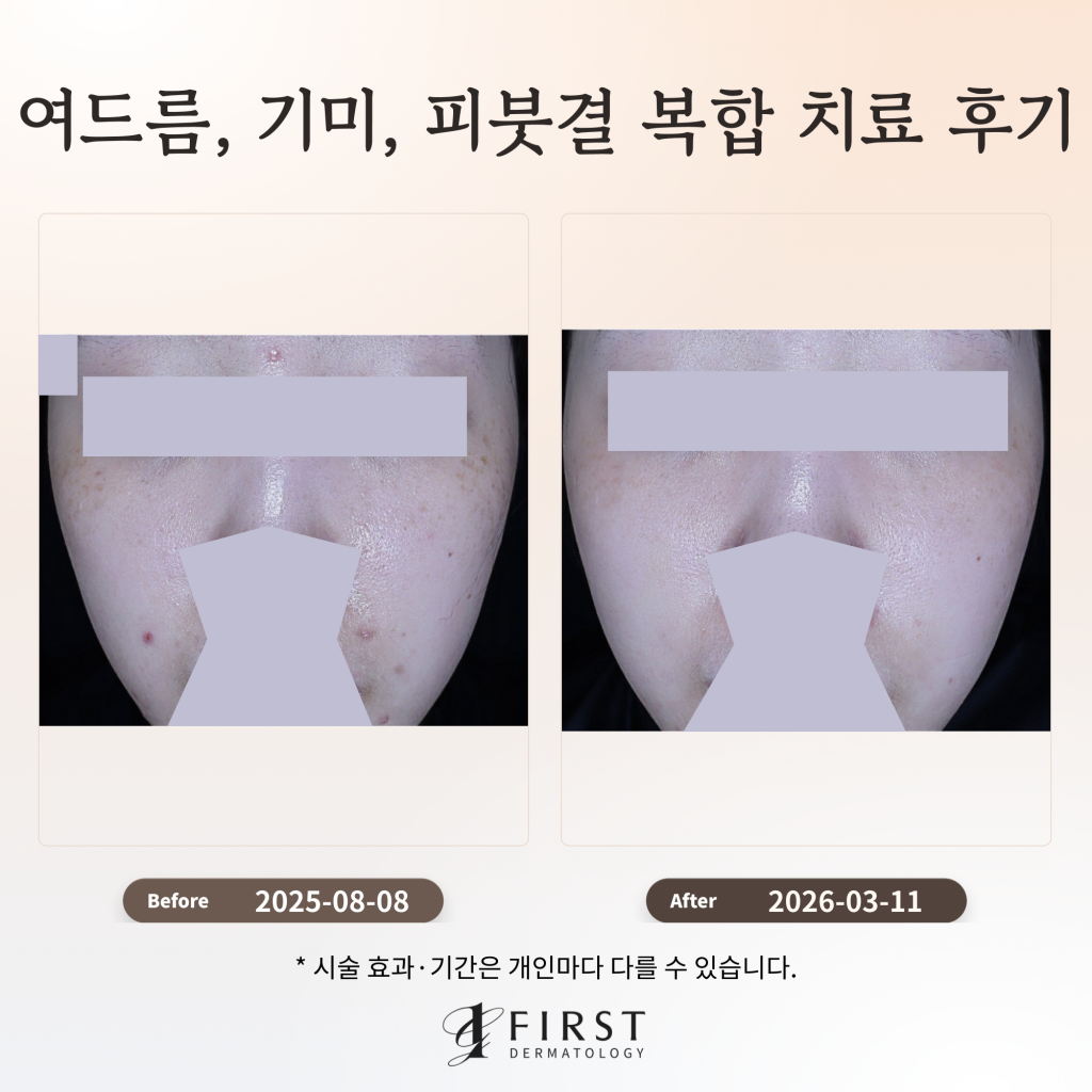 여드름, 기미, 피붓결 복합 치료 후기