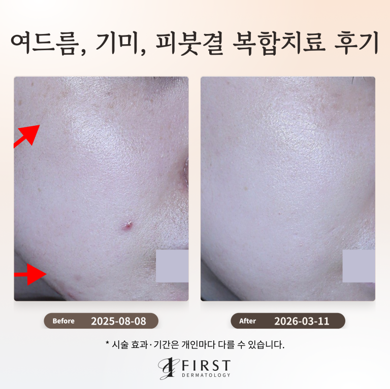 여드름, 기미, 피붓결 복합 치료 후기