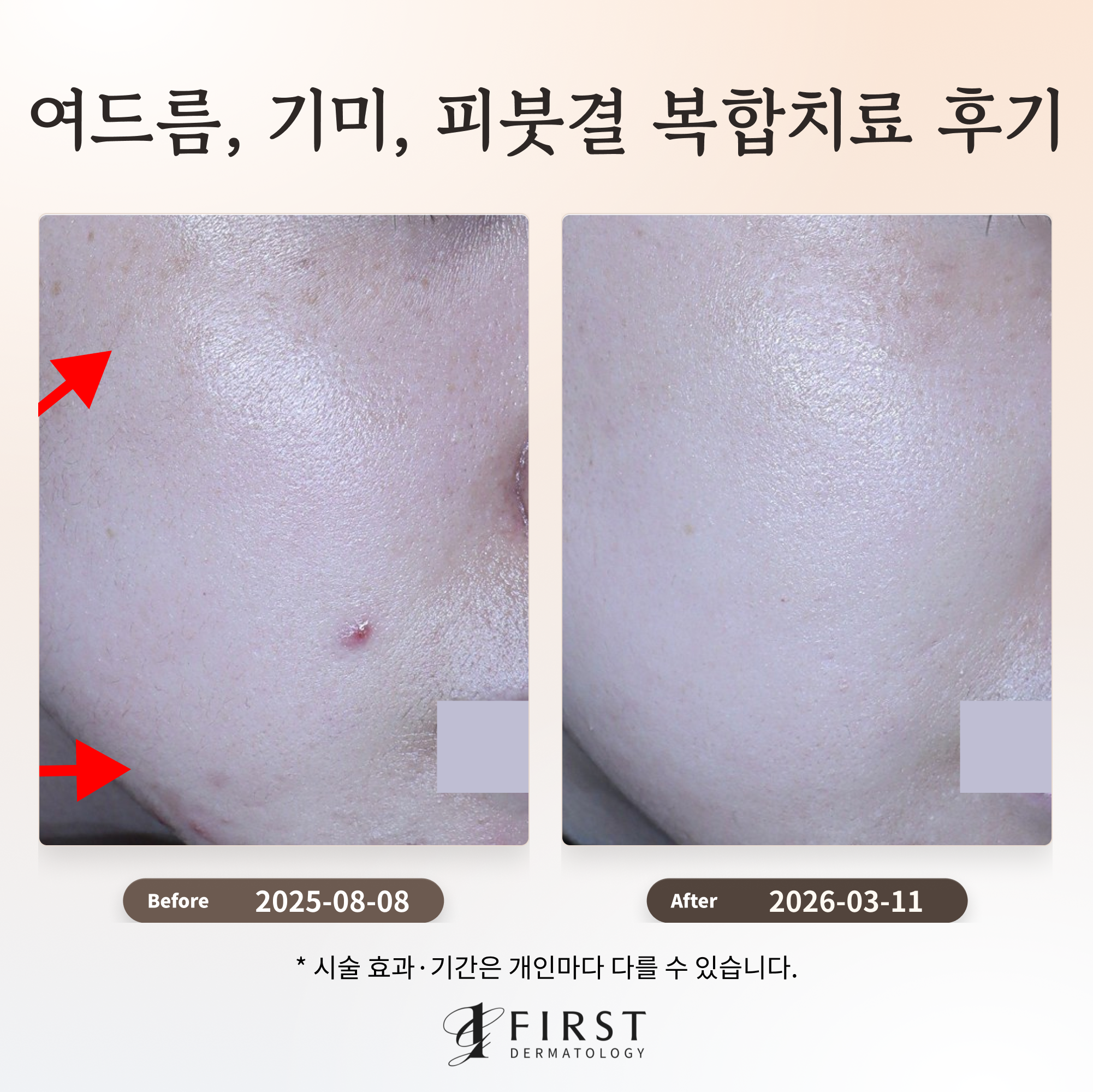 여드름, 기미, 피붓결 복합 치료 후기