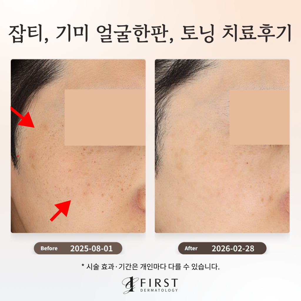 잡티 및 기미 얼굴한판, 토닝 치료 후기