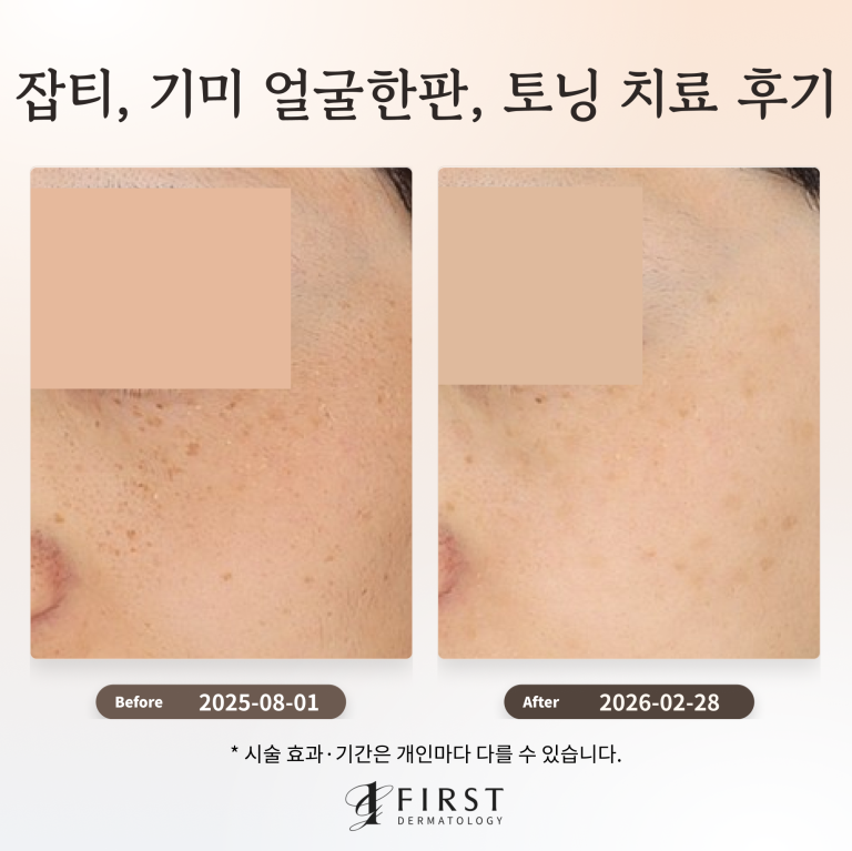 잡티 및 기미 얼굴한판, 토닝 치료 후기