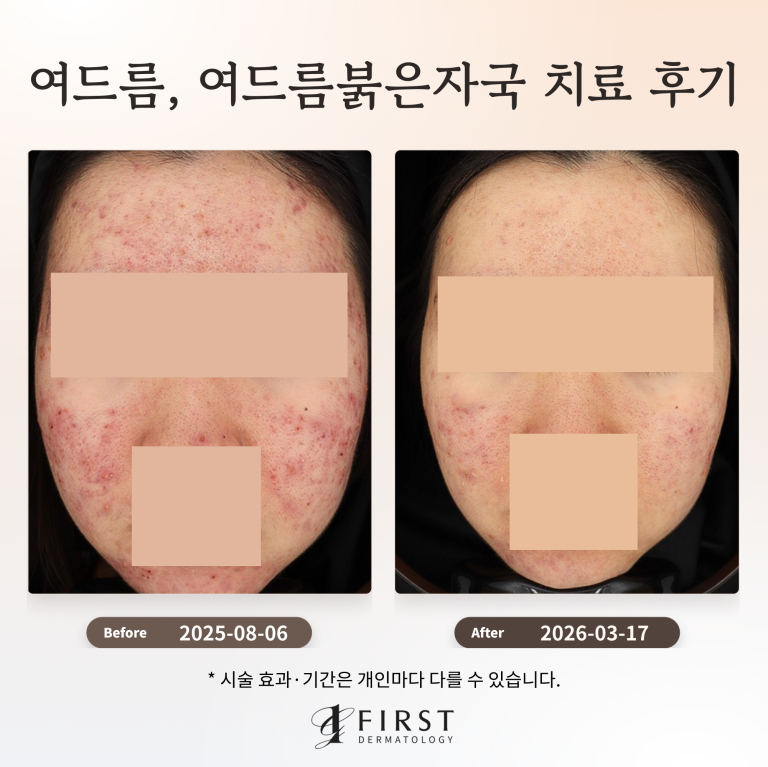 여드름, 여드름붉은자국 치료 후기