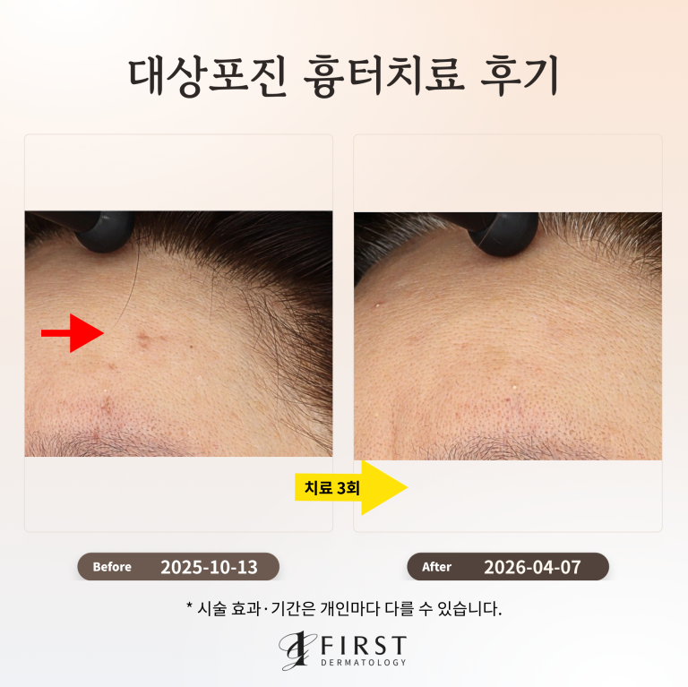 대상포진 흉터치료 후기