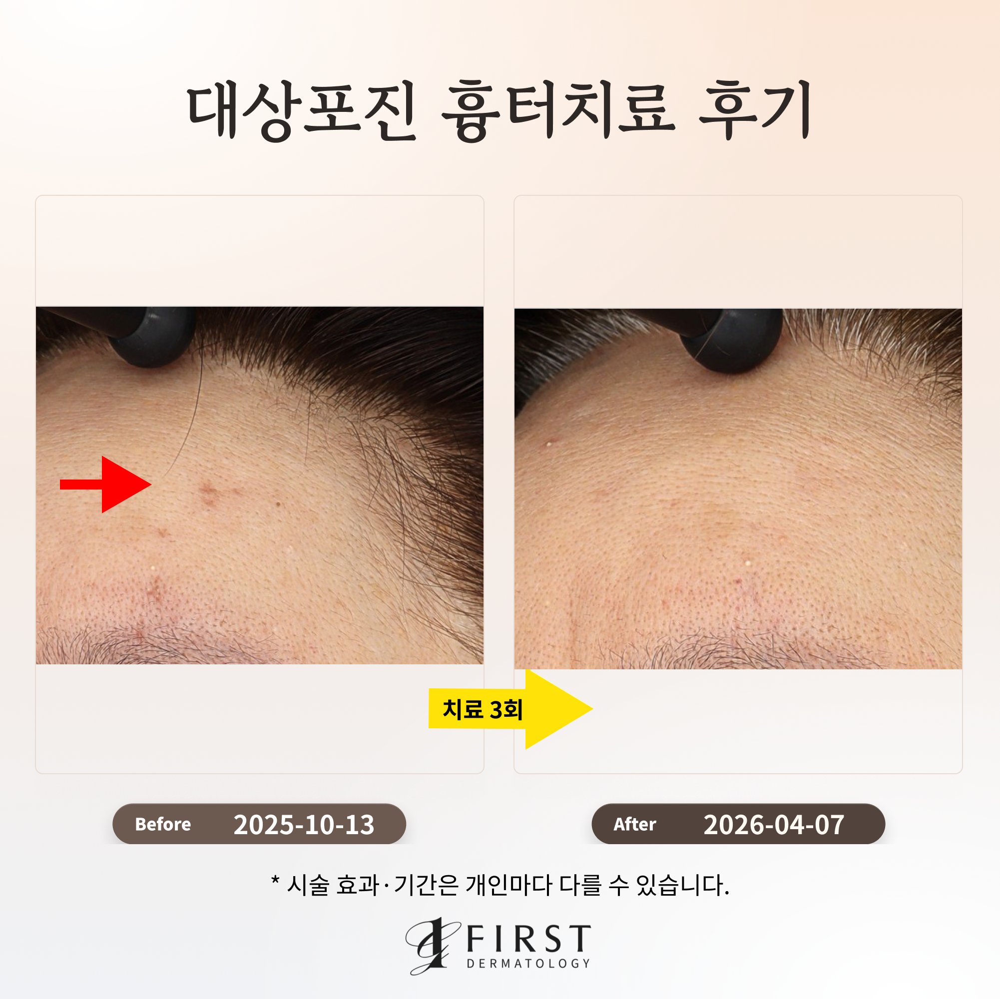 대상포진 흉터치료 후기