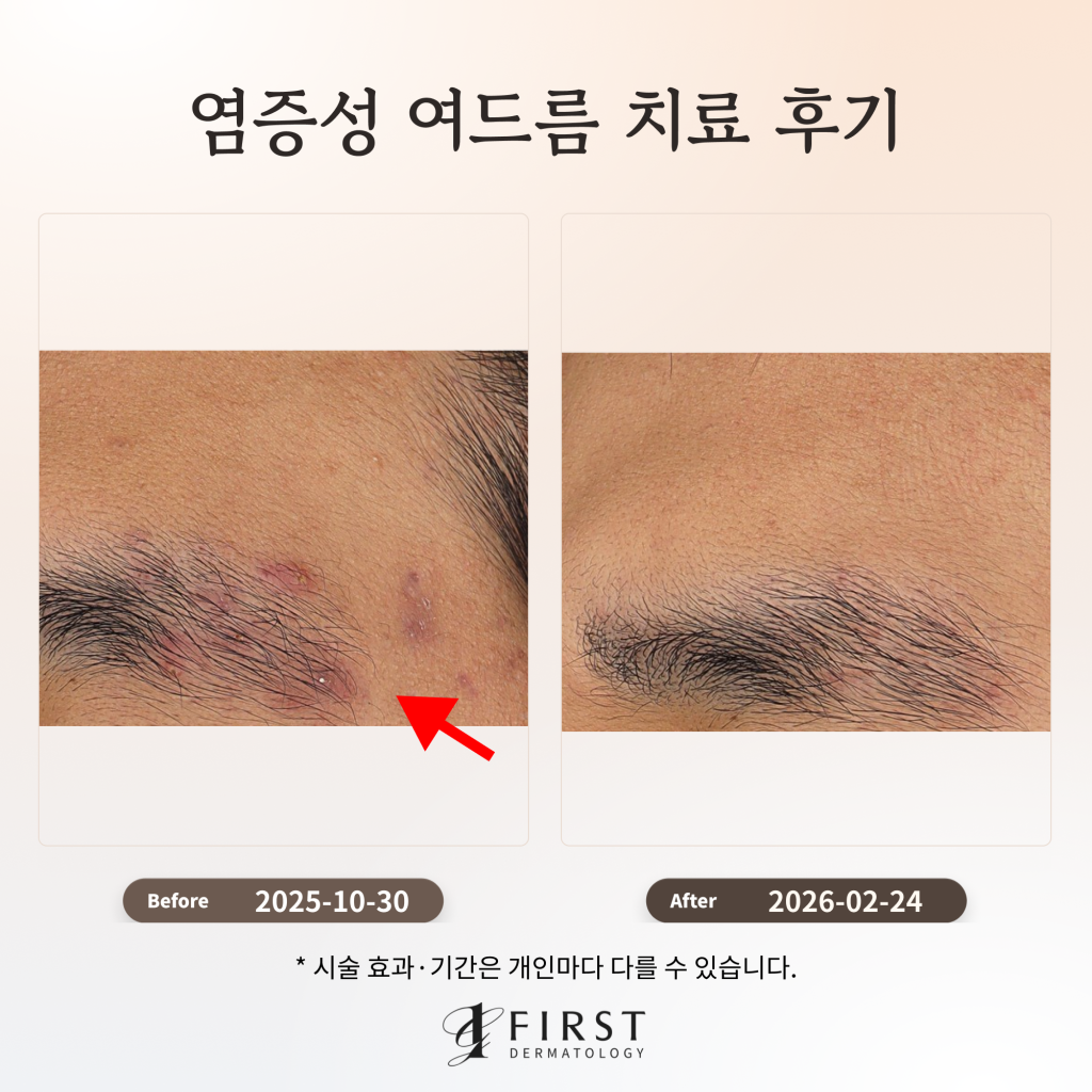 염증성 여드름 치료 후기