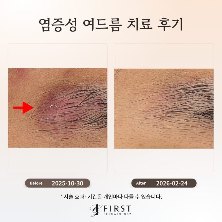 염증성 여드름 치료 후기