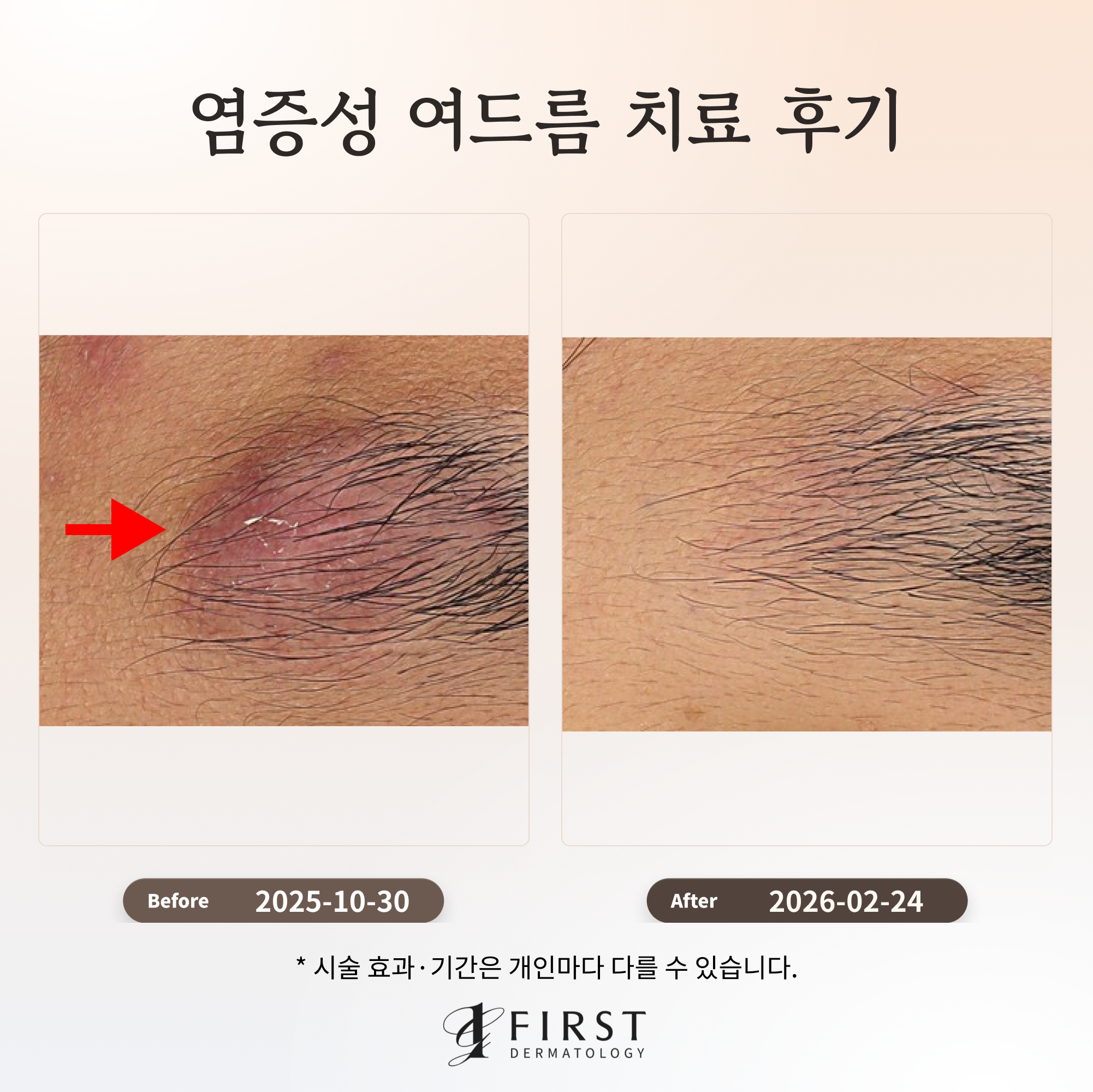 염증성 여드름 치료 후기