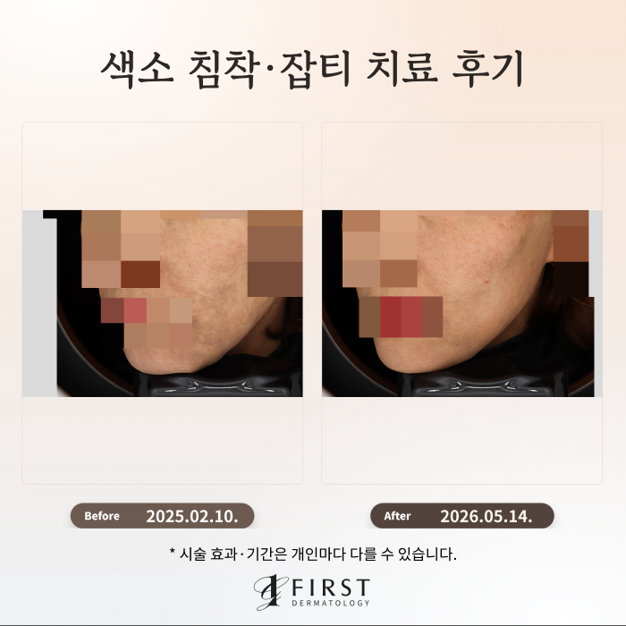 잘못된 피부관리로 생긴 색소질환 치료 후기