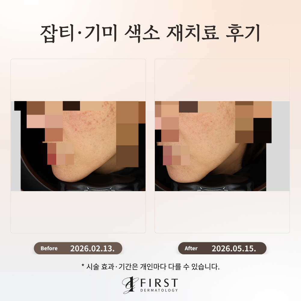 잘못된 색소 치료, 색소침착 부작용 치료 후기