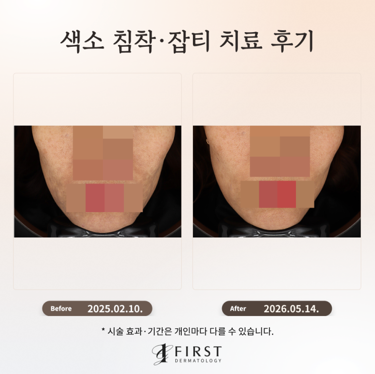 잘못된 피부관리로 생긴 색소질환 치료 후기